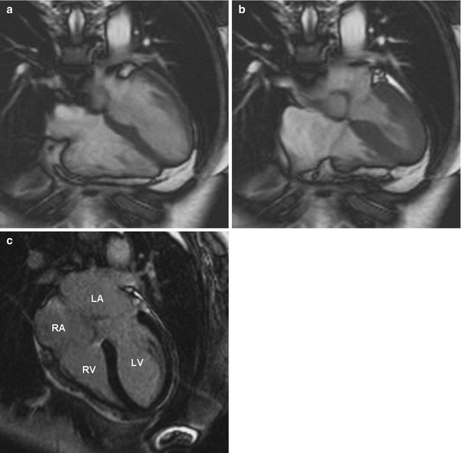 Mediastinum and Heart | Radiology Key