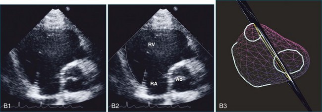 Assessment Of Right Ventricular Function Radiology Key