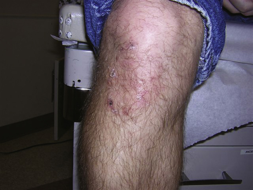 dermatitis herpetiformis elbow