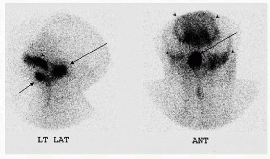 Pediatric Nuclear Medicine | Radiology Key