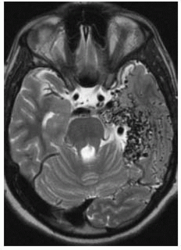 Understanding Vascular Malformations Of The Spine