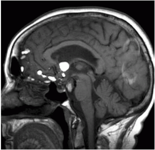 Extra Axial Masses Radiology Key