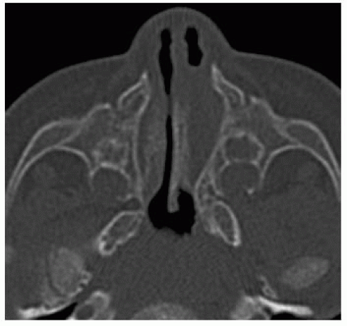 Sinonasal Cavities | Radiology Key