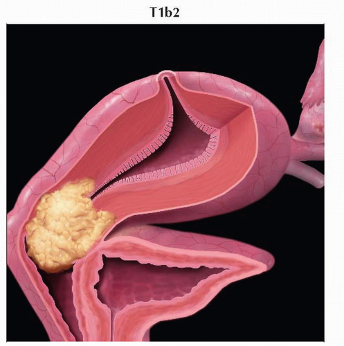 Tumors at this stage are confined to the cervix. 