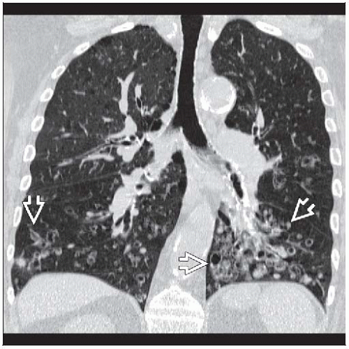 Airway Disease: Bronchiectasis, Chronic Bronchitis, and Bronchiolitis |  Radiology Key
