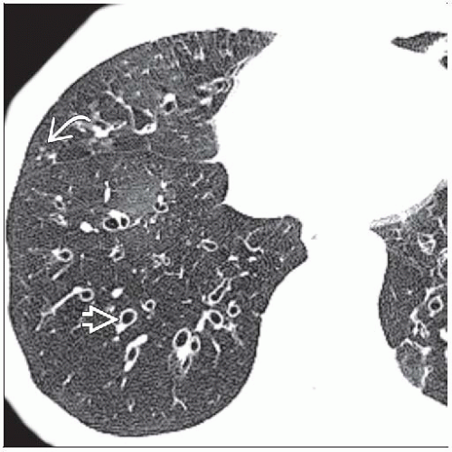 Causes Of Constrictive Bronchiolitis