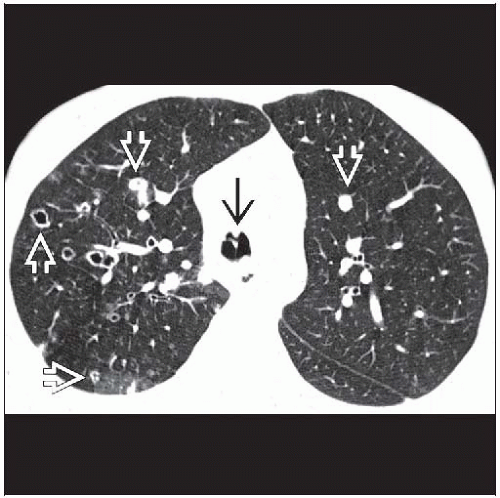 Respiratory papillomatosis ct Papillomatosis lung ct