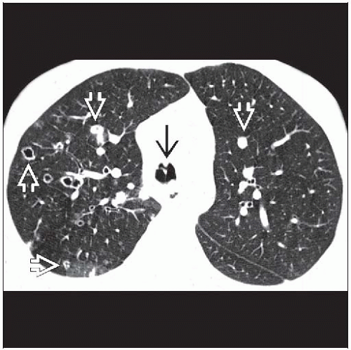 Tracheobronchial Papillomatosis Radiology Key