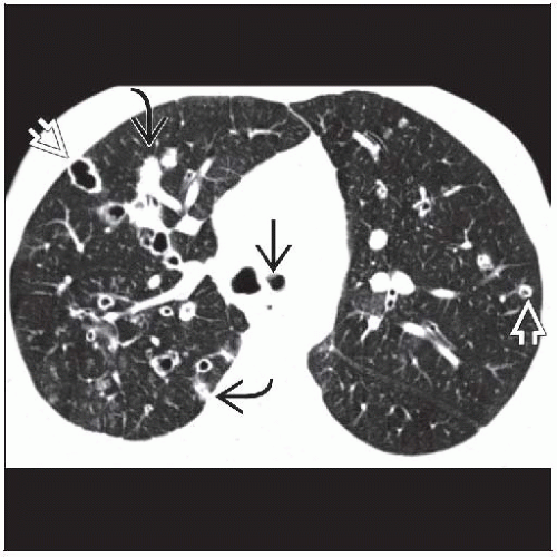 Tracheobronchialis papillomatosis