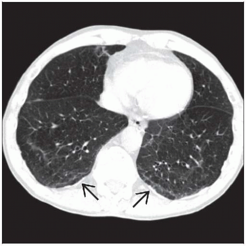 small cell lung cancer metastasized to the brain
