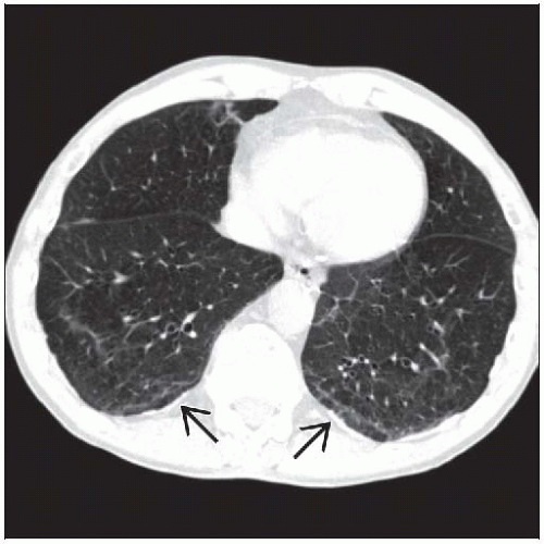 how do they treat copd