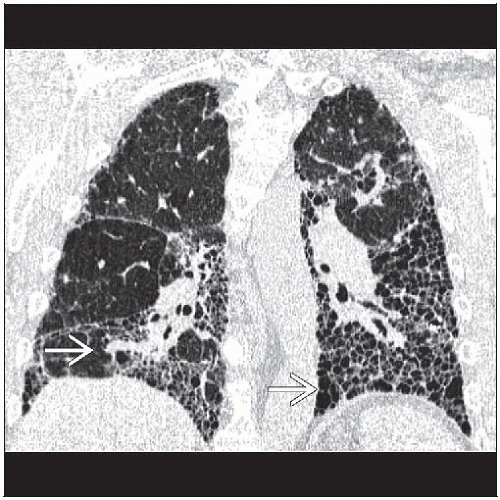 Idiopathic Pulmonary Fibrosis Radiology Key