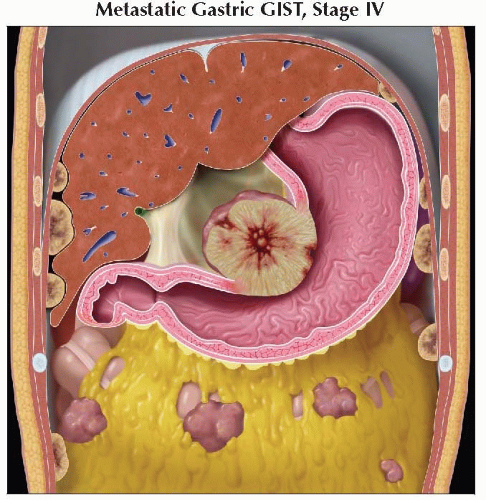 gastrointestinal-stromal-tumor-gist-radiology-key