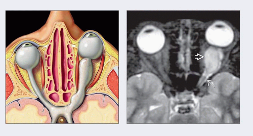 optic-pathway-glioma-radiology-key