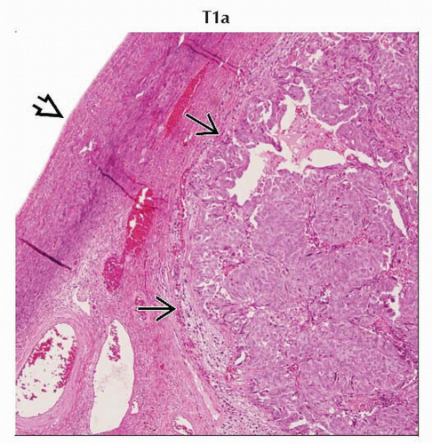 Ovarian Carcinoma | Radiology Key