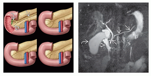 Pancreas Divisum | Radiology Key