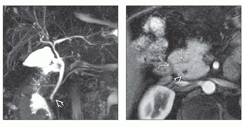 Pancreas Divisum | Radiology Key