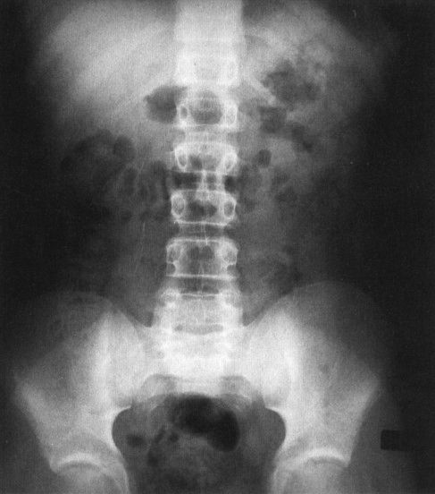 normal abdominal x ray