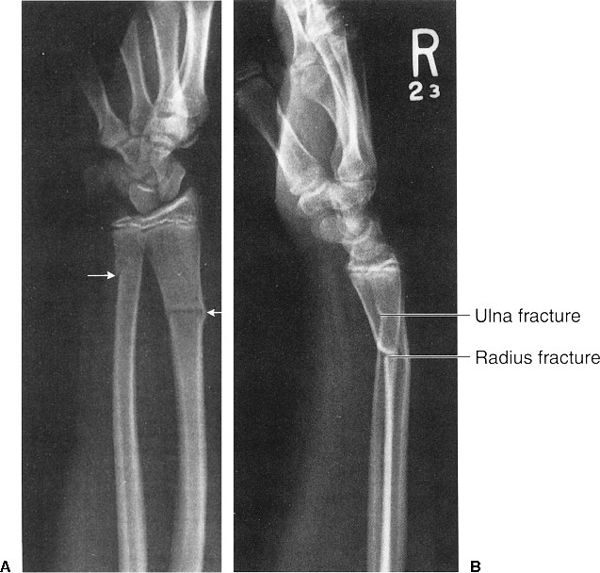 Colles fracture. Lateral (a) and AP (b) wrist radiographs. Transverse