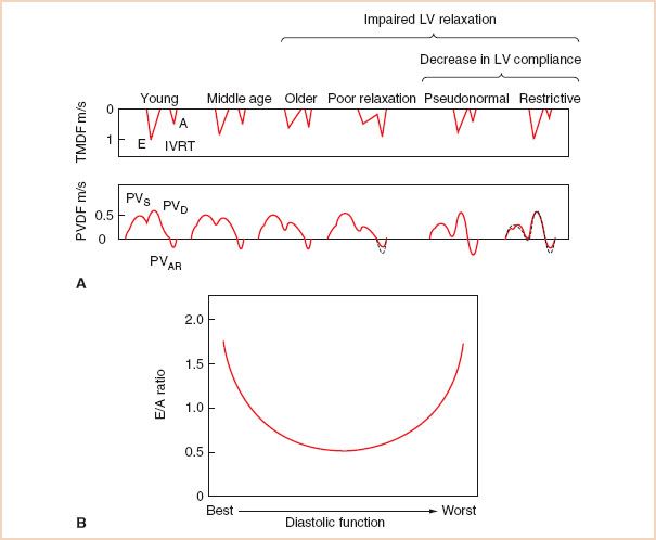 A Practical Approach to the Echocardiographic Evaluation of Ventricular Diastolic Function ...