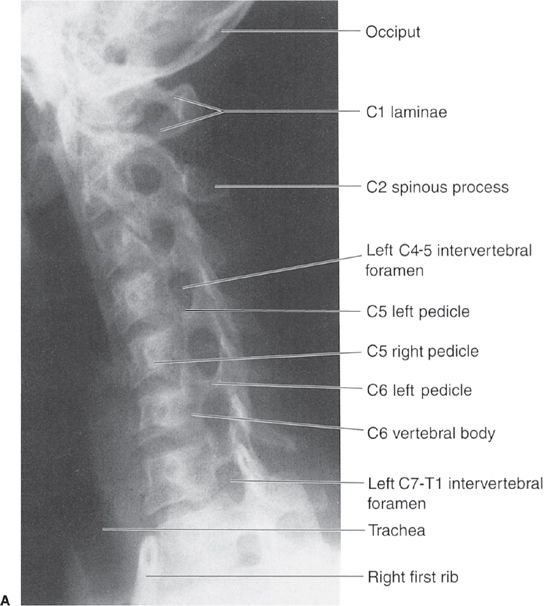 oblique cervical spine x ray