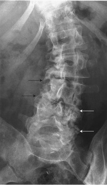 Spine and Pelvis | Radiology Key