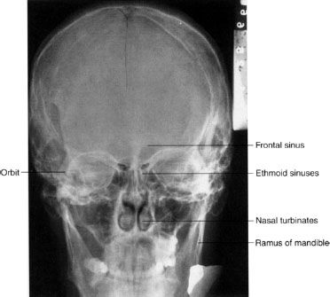Caldwell Skull X Ray