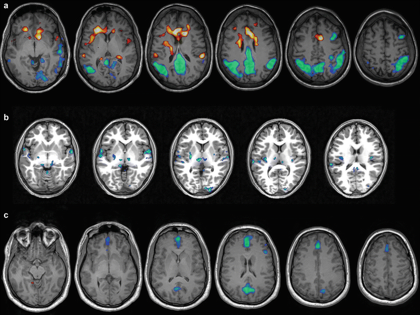 EEG-fMRI in Epilepsy | Radiology Key