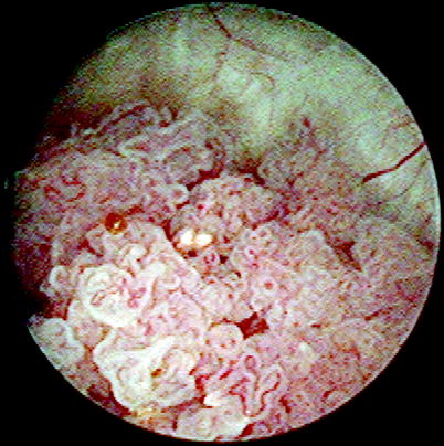 papillary lesion in bladder)