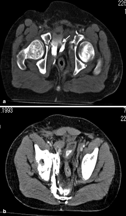 Bladder Trauma | Radiology Key