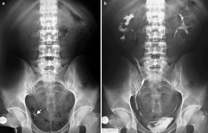 Renal Calculus Disease | Radiology Key