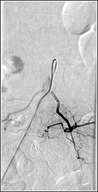 Anterior Spinal Artery Angiogram