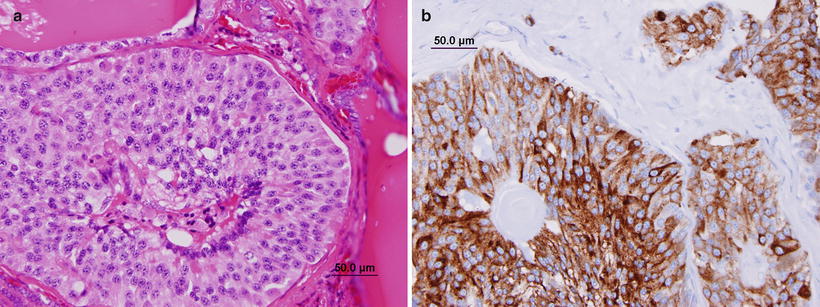 Pediatric Cancer in the Head and Neck | Radiology Key