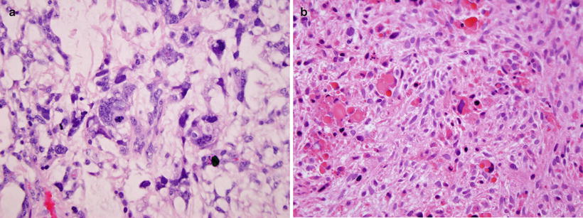 Gastrointestinal, Pancreatic and Hepatic Malignancies in Children ...