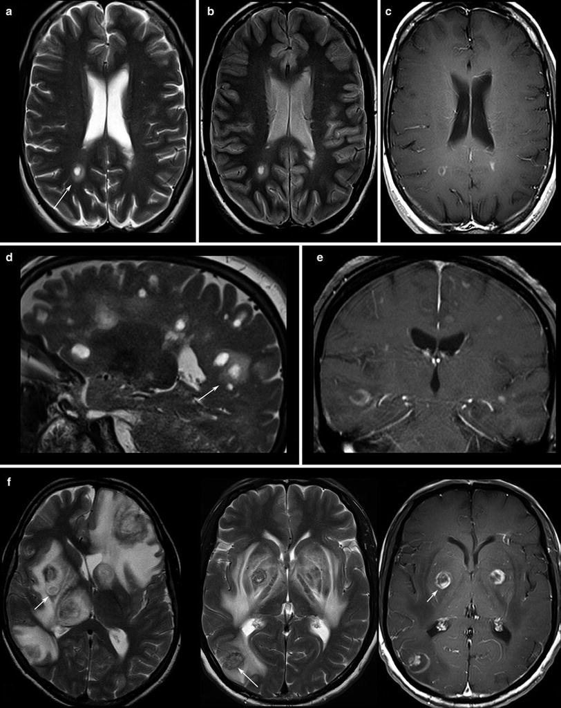 Imaging of Brain Tumors | Radiology Key