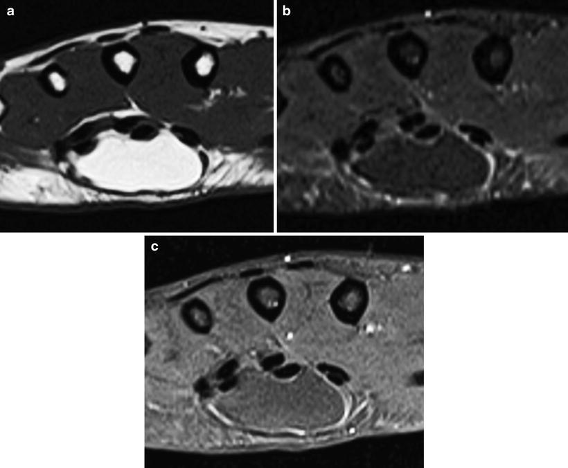 MR Imaging for the Orthopedic Surgeon | Radiology Key