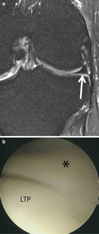 Diagnostic Knee Arthroscopy And Arthroscopic Anatomy | Radiology Key