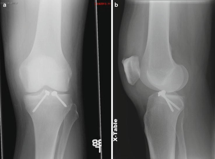 Anterior Cruciate Ligament Injury And Reconstruction | Radiology Key