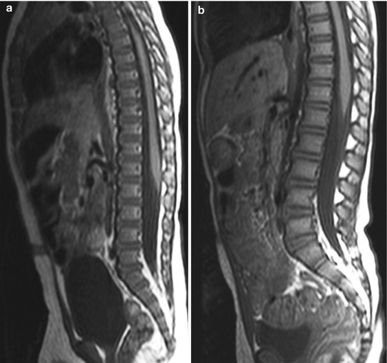 bone marrow degenerative changes