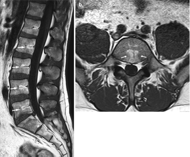 The Abnormal Bone Marrow: MRI Patterns | Radiology Key