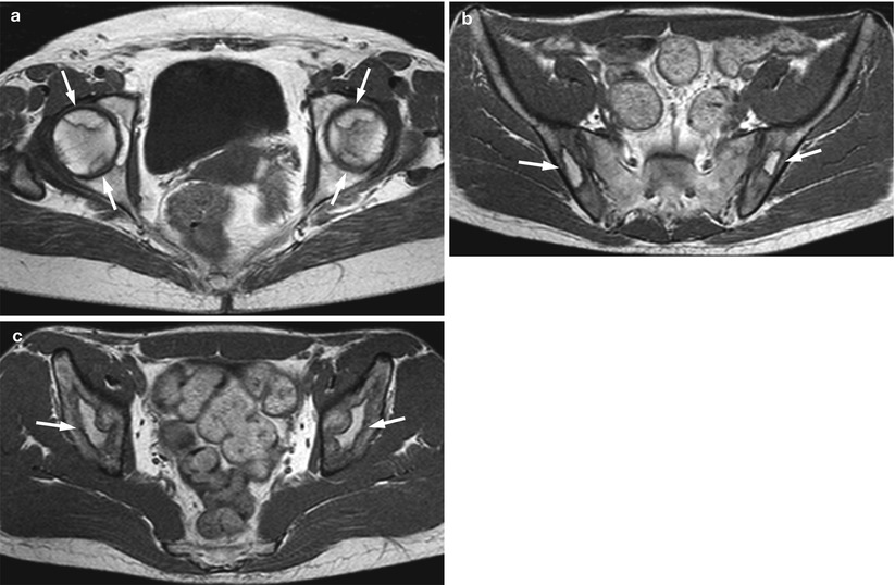The Abnormal Bone Marrow: MRI Patterns | Radiology Key