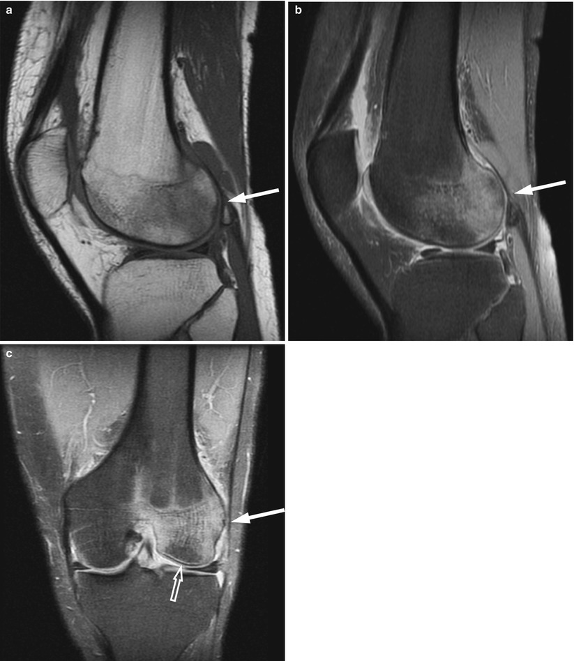 bone-marrow-edema-pattern-radiology-key