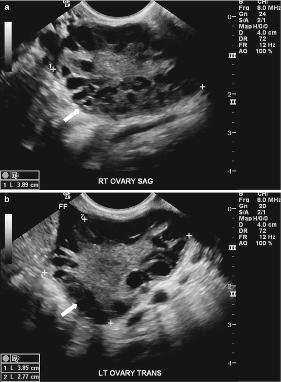 A–C) Sonograms of the dominant follicle (Ø 22, 32 and 38 mm) in a