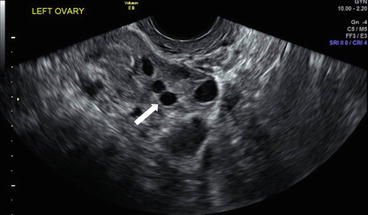 Ovarian Follicles Ultrasound