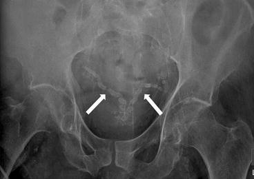 pelvis radiology calcifications male fig