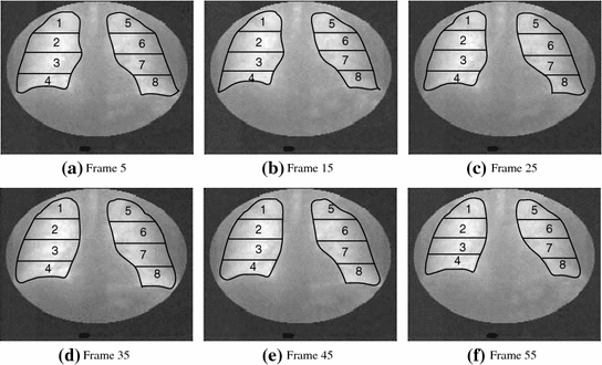 the Shape and Motion of the Lungs and Heart in Dynamic Pulmonary ...