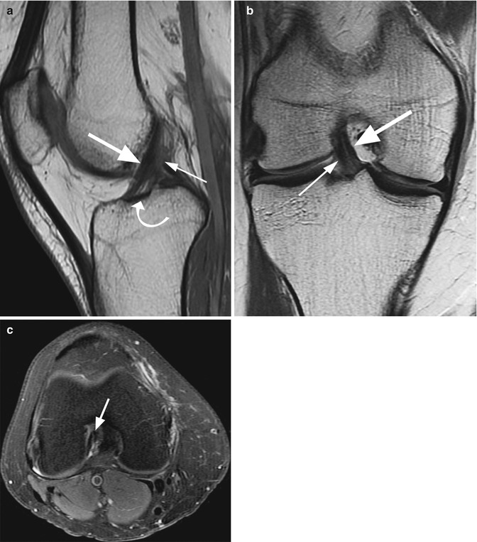 Xknee Startradiology Cruciate Ligament Radiology