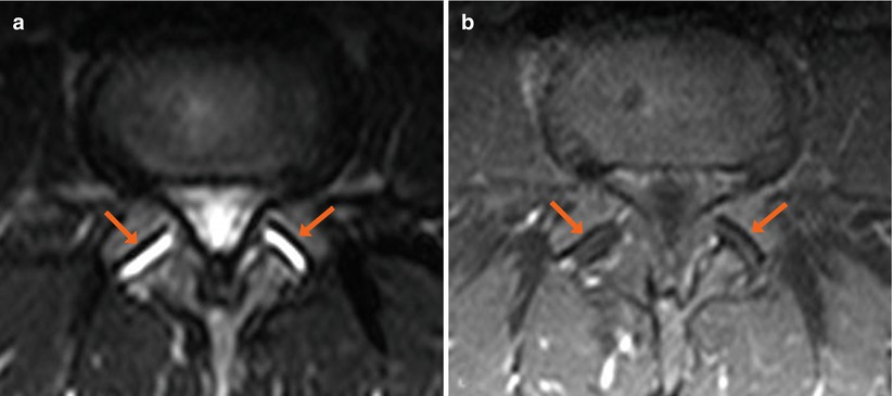 facet-joint-effusion-radiology-key