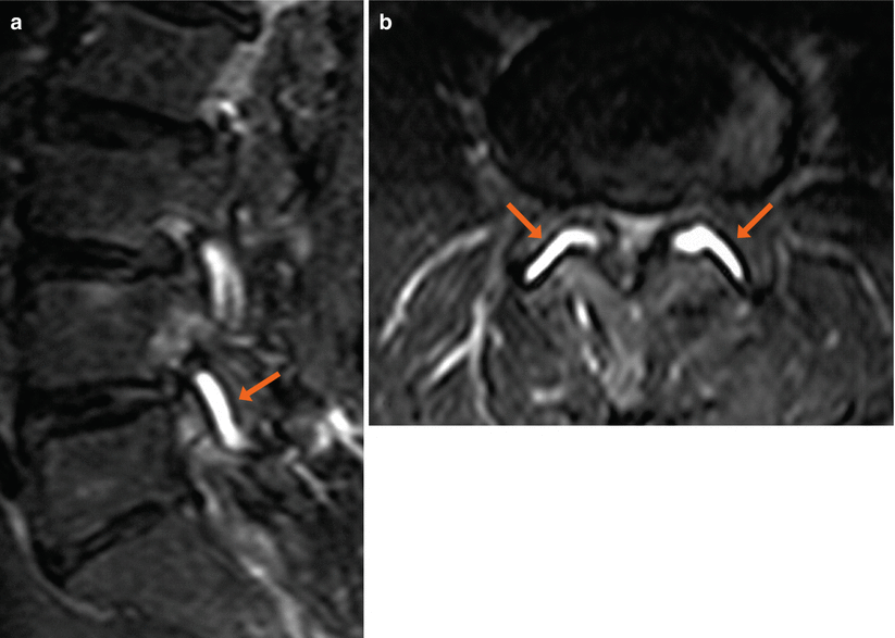 Facet Joint Effusion Radiology Key