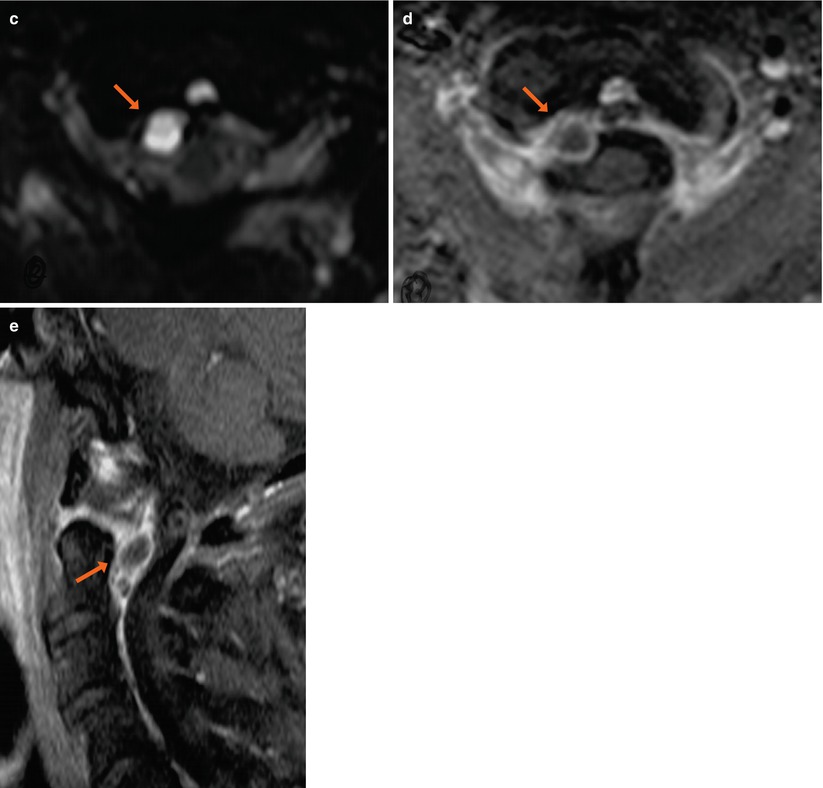 Synovial Cyst Pathology 2239